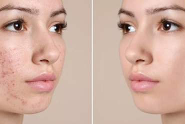 🌸 TRỊ NÁM CHUYÊN SÂU TẠI LBA – ĐÁNH BẬT SẮC TỐ, TRẢ LẠI LÀN DA SÁNG MỊN 🌸