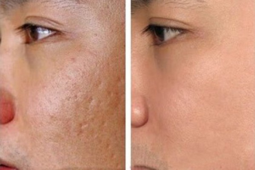 🌸 TRỊ NÁM CHUYÊN SÂU TẠI LBA – ĐÁNH BẬT SẮC TỐ, TRẢ LẠI LÀN DA SÁNG MỊN 🌸